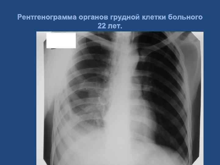 Рентгенограмма органов грудной клетки больного 22 лет. 