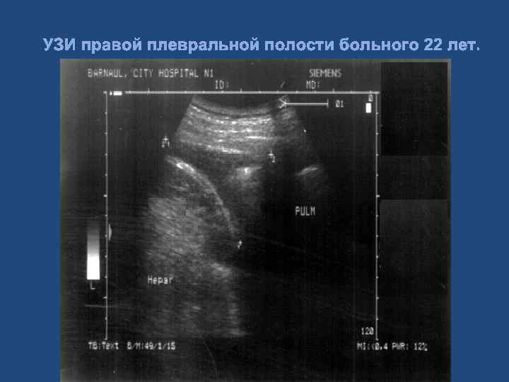 Узи легких протокол и плевры образец