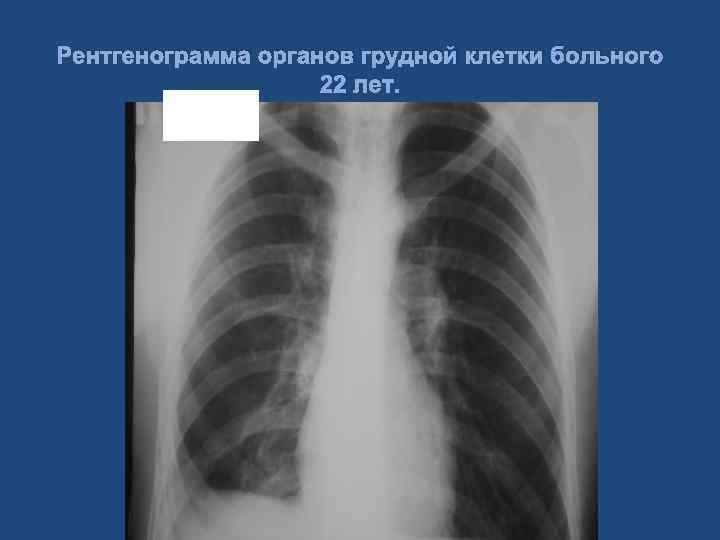 Рентгенограмма органов грудной клетки больного 22 лет. 