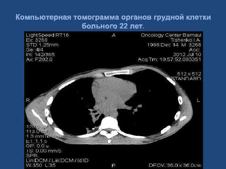 Компьютерная томограмма органов грудной клетки больного 22 лет. 