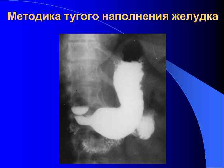 Методика тугого наполнения желудка 