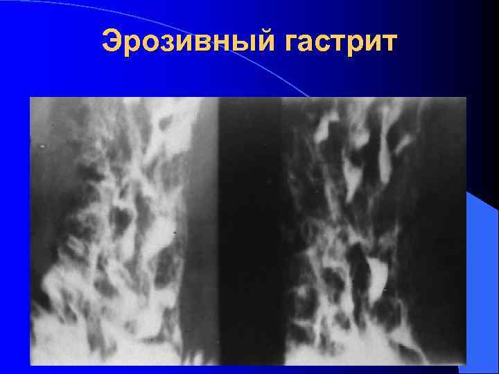 Эрозивный гастрит 