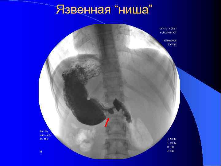 Язвенная “ниша” 