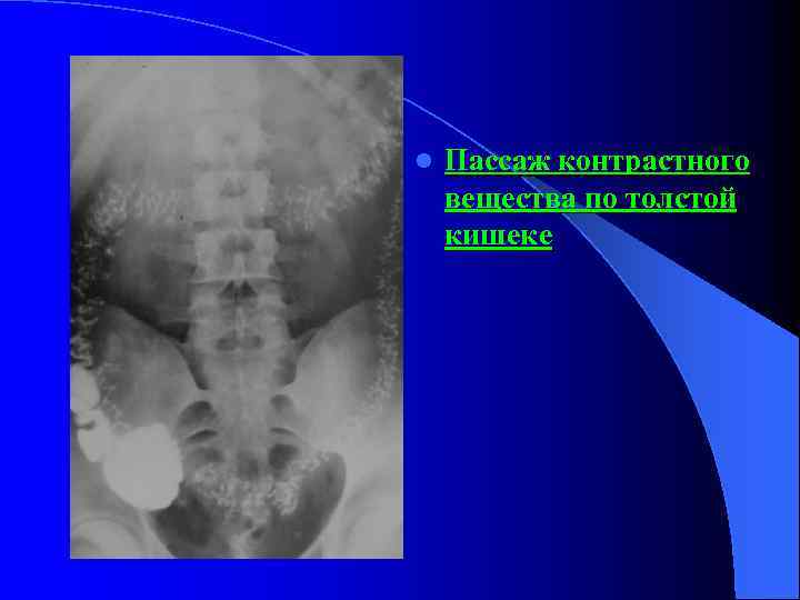 l Пассаж контрастного вещества по толстой кишеке 