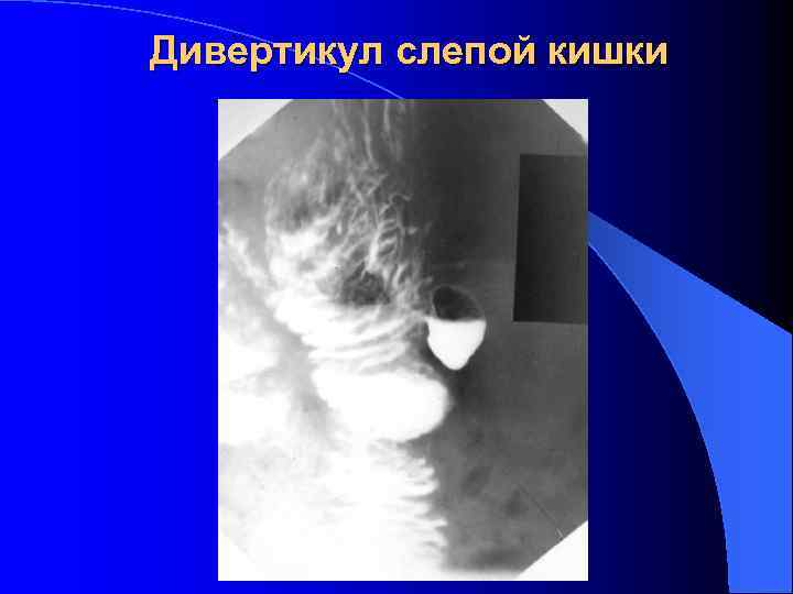 Дивертикул слепой кишки 