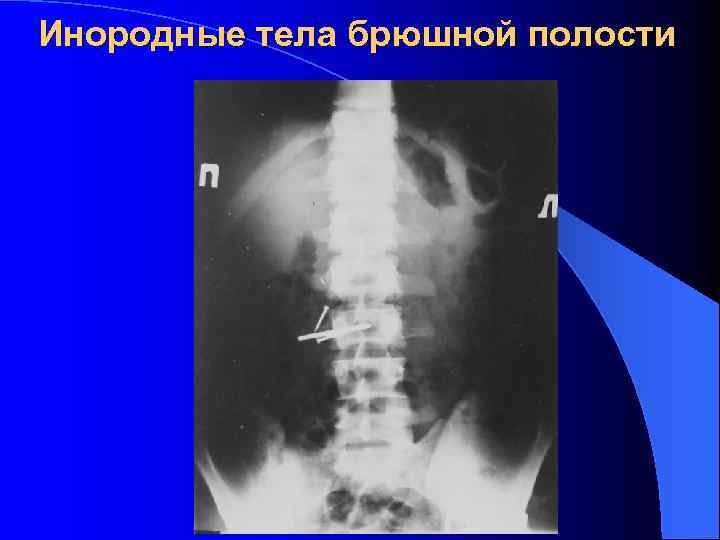 Презентация инородные тела жкт