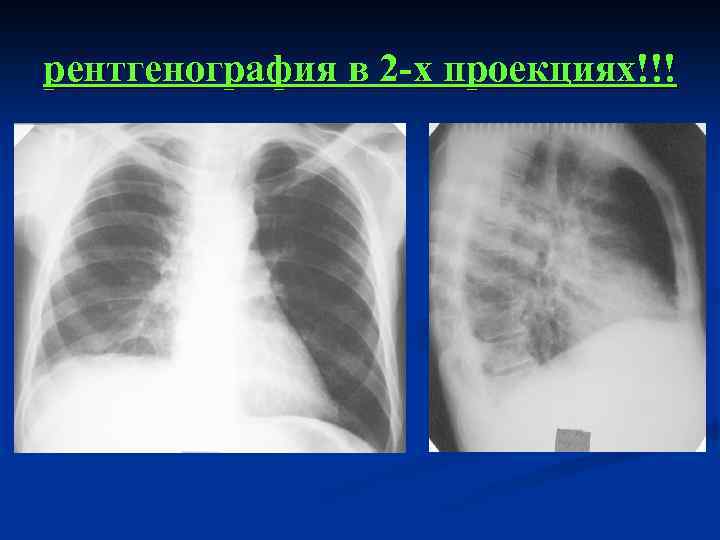 Рентген в двух проекциях. Флюорография (рентгенография) легких в 2 проекциях. Рентгенография грудной клетки в 2-х проекциях. Рентгенография грудной клетки в 2 проекциях. Флюорография грудной клетки в 2-х проекциях.