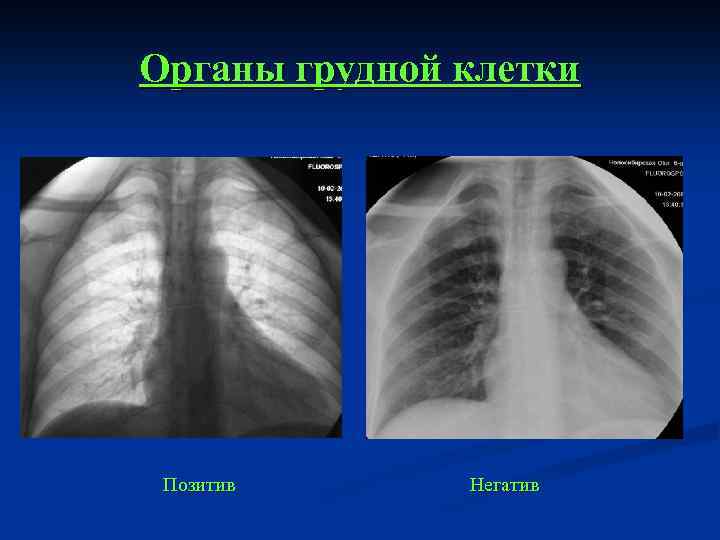 Негативное изображение рентген