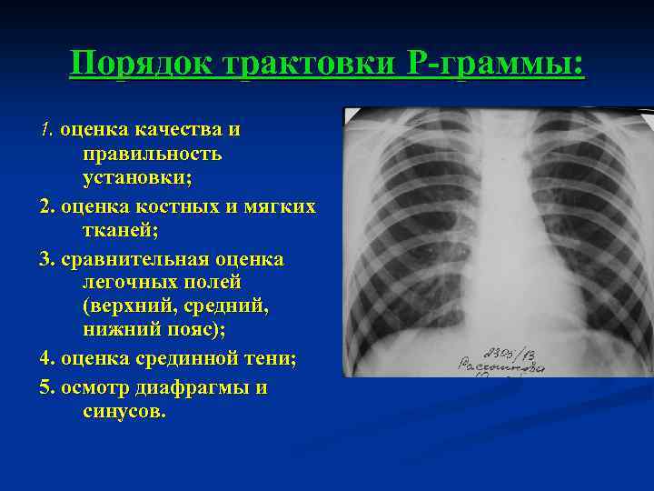 Поле легкого. Легочные поля. Легочные поля рентген. Сравнительная оценка легочных полей. Поля легких на рентгене.