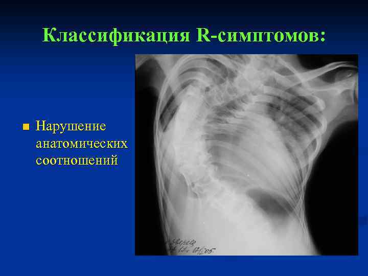 Классификация R-симптомов: n Нарушение анатомических соотношений 