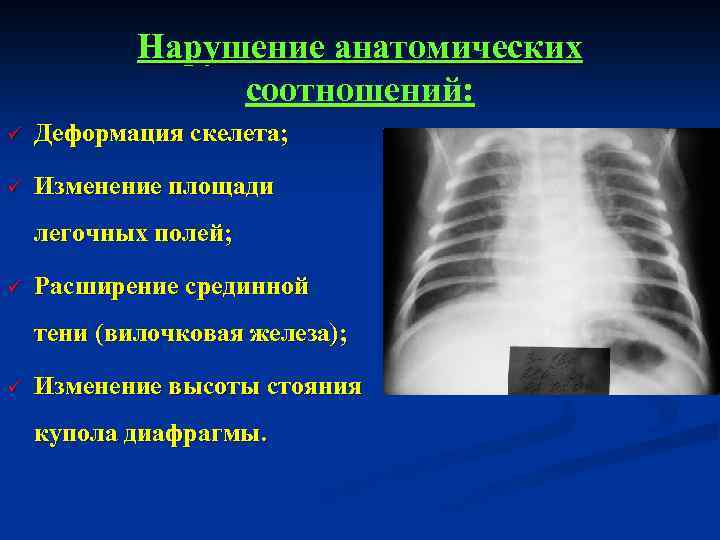 Нарушение анатомических соотношений: ü Деформация скелета; ü Изменение площади легочных полей; ü Расширение срединной