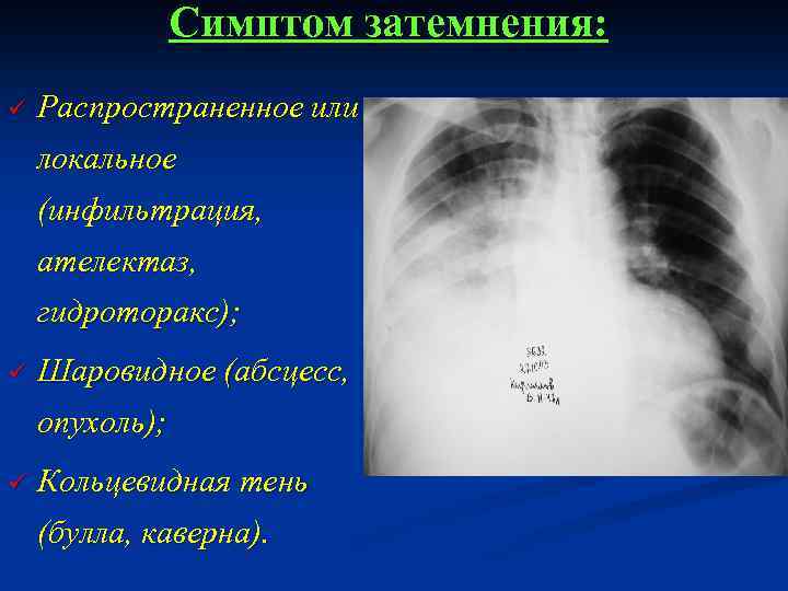 Признаки гидроторакса. Пневмония и гидроторакс на рентгене. Кольцевидные тени в легких на рентгене. Гидроторакс при гидротораксе. Гидроторакс локальный статус.