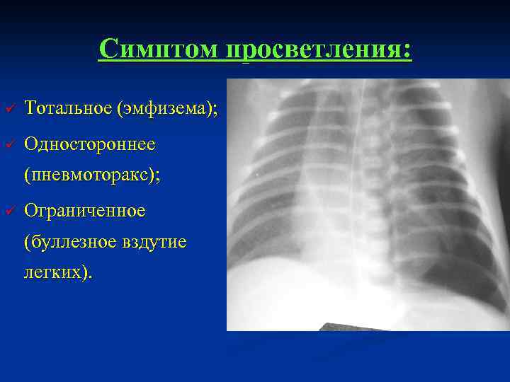 Симптом просветления: ü Тотальное (эмфизема); ü Одностороннее (пневмоторакс); ü Ограниченное (буллезное вздутие легких). 