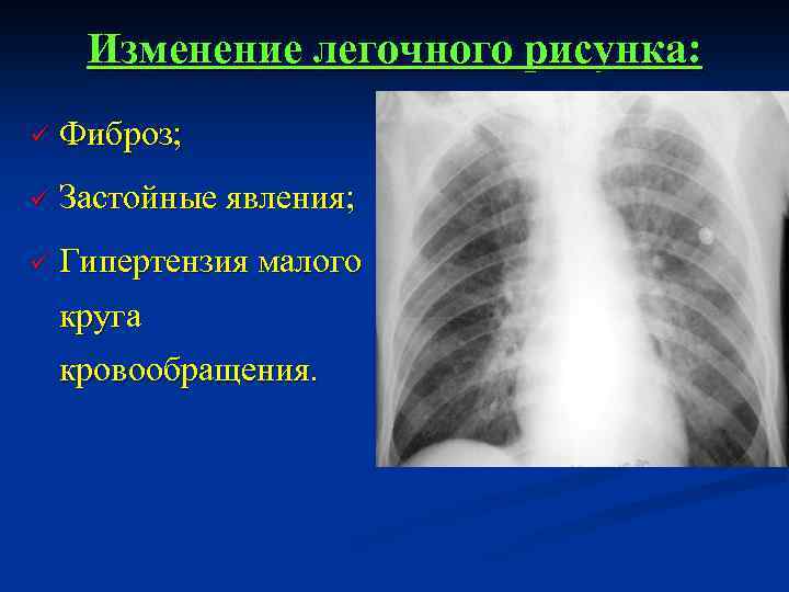 Изменение легочного рисунка: ü Фиброз; ü Застойные явления; ü Гипертензия малого круга кровообращения. 