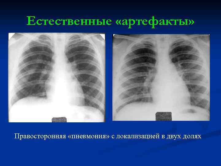 Естественные «артефакты» Правосторонняя «пневмония» с локализацией в двух долях 