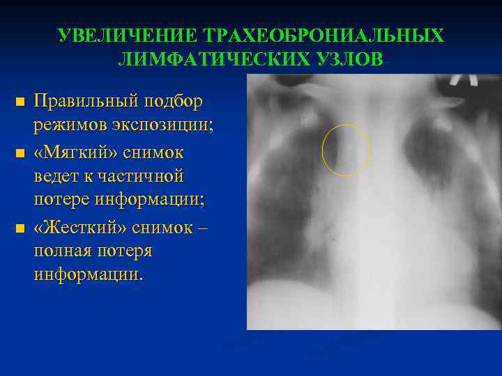 УВЕЛИЧЕНИЕ ТРАХЕОБРОНИАЛЬНЫХ ЛИМФАТИЧЕСКИХ УЗЛОВ n n n Правильный подбор режимов экспозиции; «Мягкий» снимок ведет