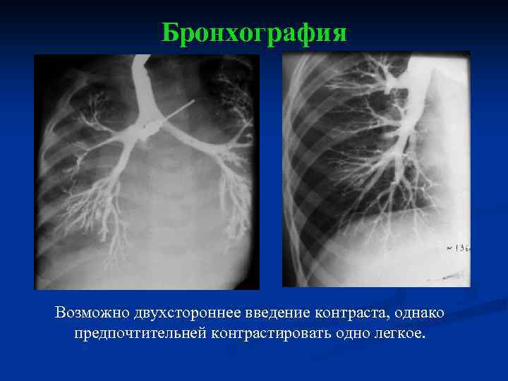 Бронхография Возможно двухстороннее введение контраста, однако предпочтительней контрастировать одно легкое. 