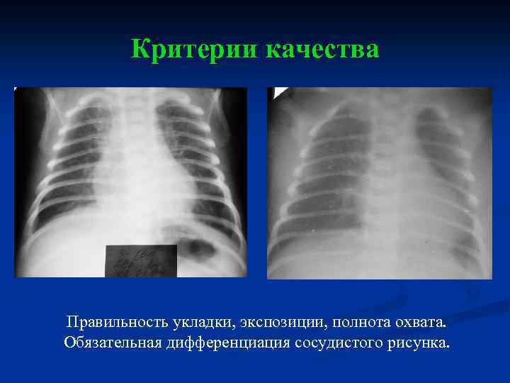 Критерии качества Правильность укладки, экспозиции, полнота охвата. Обязательная дифференциация сосудистого рисунка. 