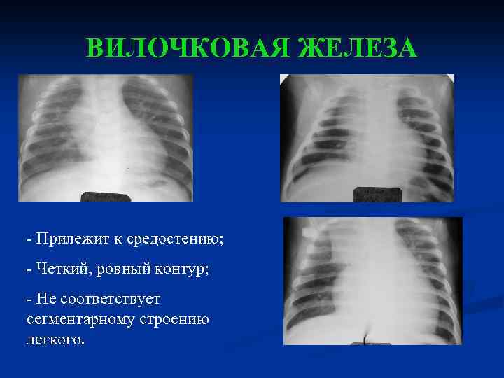 ВИЛОЧКОВАЯ ЖЕЛЕЗА - Прилежит к средостению; - Четкий, ровный контур; - Не соответствует сегментарному