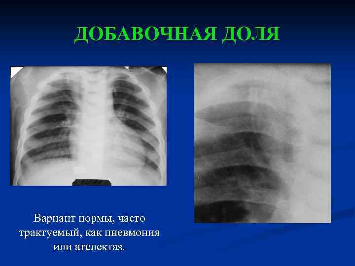 ДОБАВОЧНАЯ ДОЛЯ Вариант нормы, часто трактуемый, как пневмония или ателектаз. 