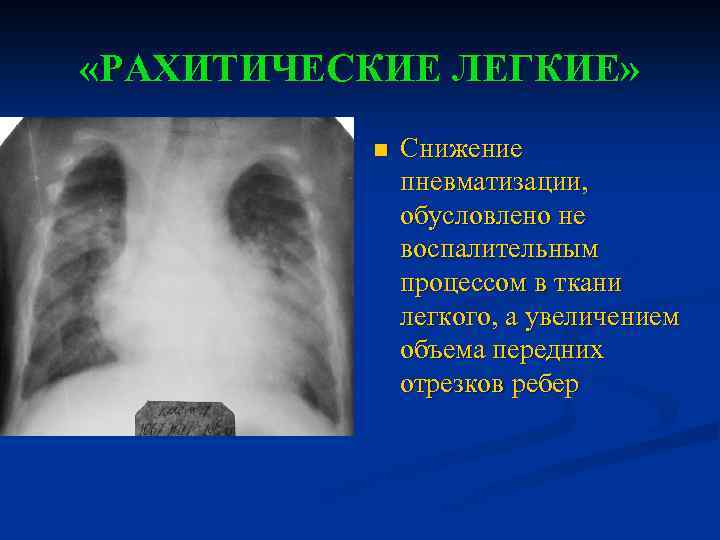  «РАХИТИЧЕСКИЕ ЛЕГКИЕ» n Снижение пневматизации, обусловлено не воспалительным процессом в ткани легкого, а