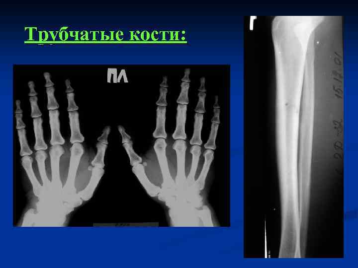 Трубчатые кости: 