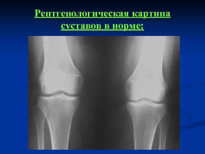 Рентгенологическая картина суставов в норме: 