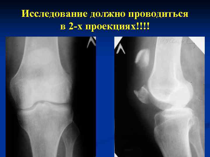 Исследование должно проводиться в 2 -х проекциях!!!! 