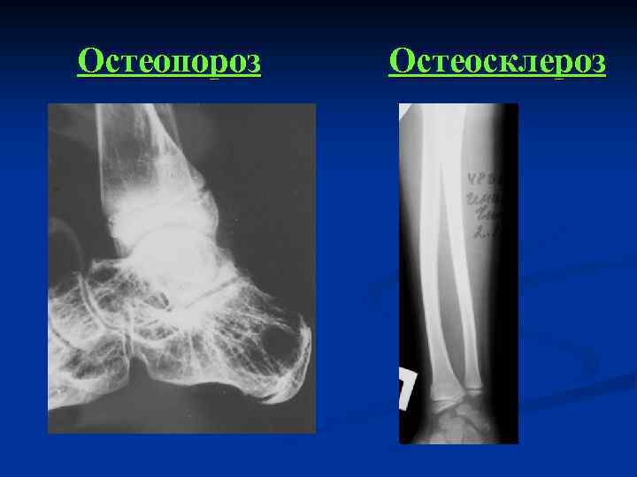 Остеопороз Остеосклероз 