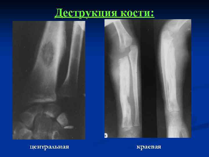 Деструкция костной ткани. Деструкция кости рентгенограмма. Костная деструкция рентген. Деструкция кости на рентгене. Костная деструкция на рентгенограмме.