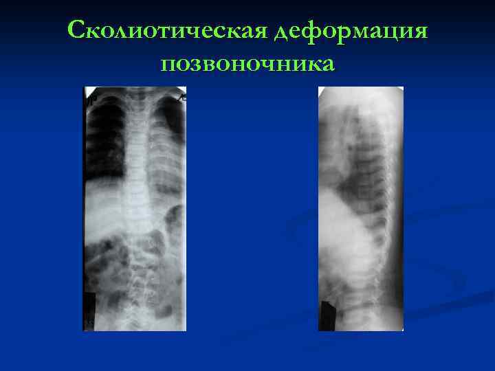 Сколиотическая деформация позвоночника 