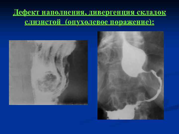 Дефект наполнения, дивергенция складок слизистой (опухолевое поражение): 