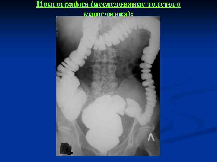 Иригография (исследование толстого кишечника): 