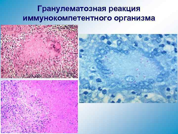 Гранулематозная реакция иммунокомпетентного организма 