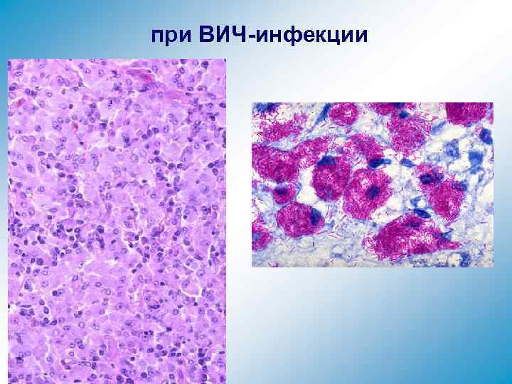 при ВИЧ-инфекции 