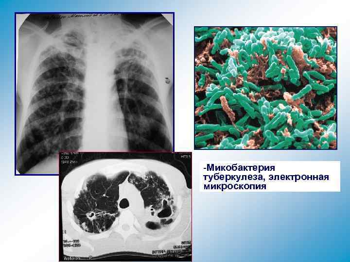 -Микобактерия туберкулеза, электронная микроскопия 