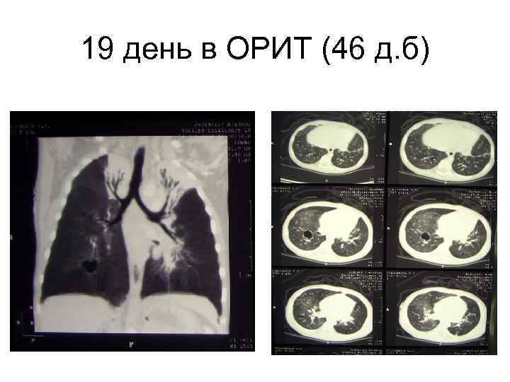 19 день в ОРИТ (46 д. б) 