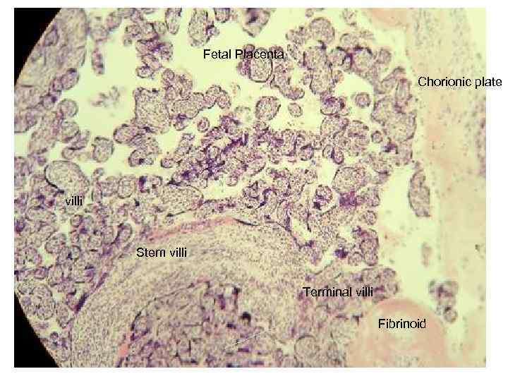 Fetal Placenta Chorionic plate villi Stem villi Terminal villi Fibrinoid 