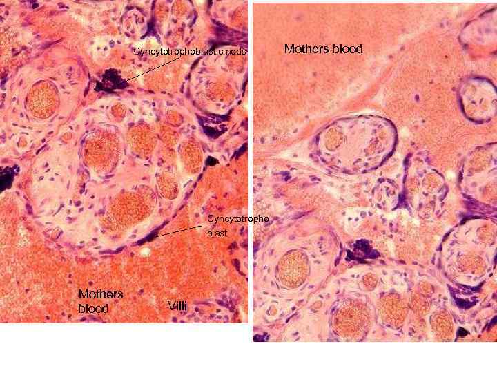 Cyncytotrophoblastic nods Cyncytotropho blast Mothers blood Villi Mothers blood 