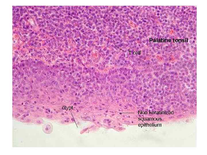 Palatine tonsil T cell crypt Non keratinized squamous epithelium 