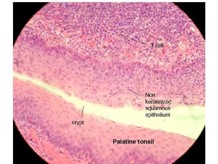 T cell Non keratinized squamous epithelium crypt Palatine tonsil 