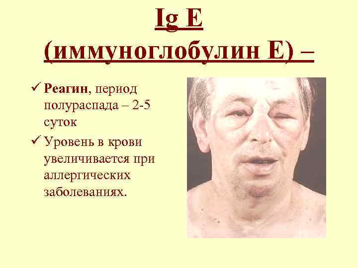 Ig Е (иммуноглобулин Е) – ü Реагин, период полураспада – 2 -5 суток ü