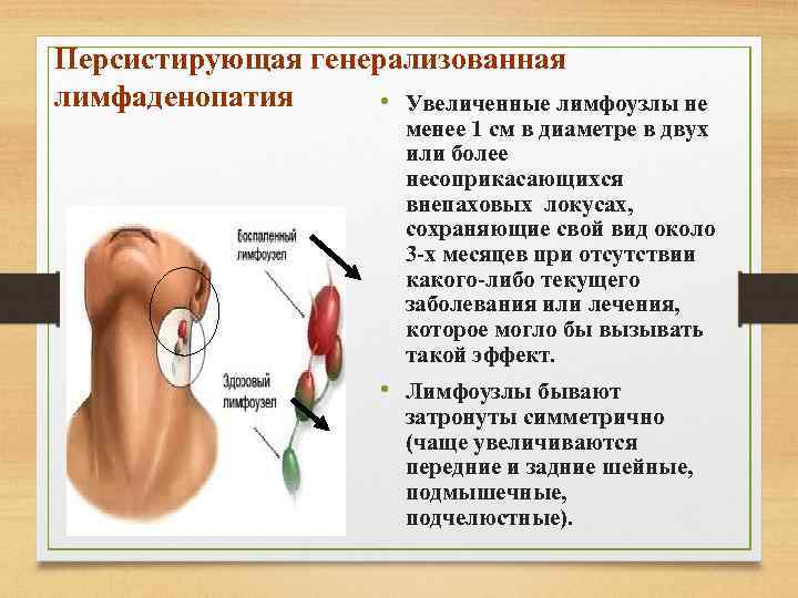 Персистирующая генерализованная лимфаденопатия • Увеличенные лимфоузлы не менее 1 см в диаметре в двух