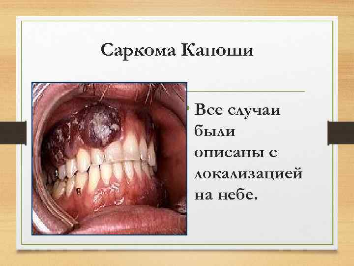 Саркома Капоши • Все случаи были описаны с локализацией на небе. 