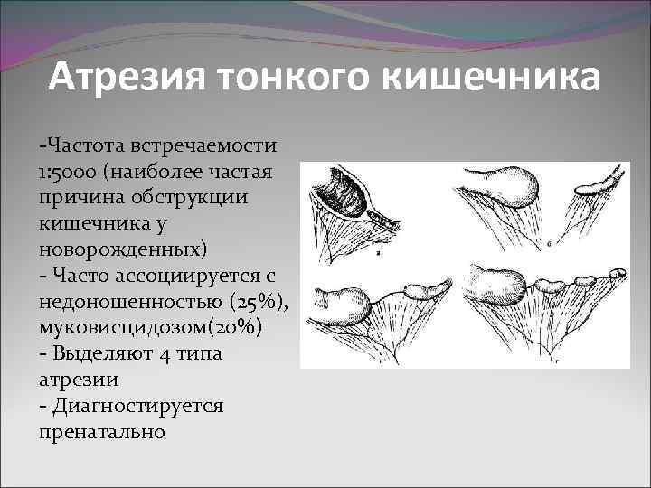 Атрезия тонкого кишечника -Частота встречаемости 1: 5000 (наиболее частая причина обструкции кишечника у новорожденных)