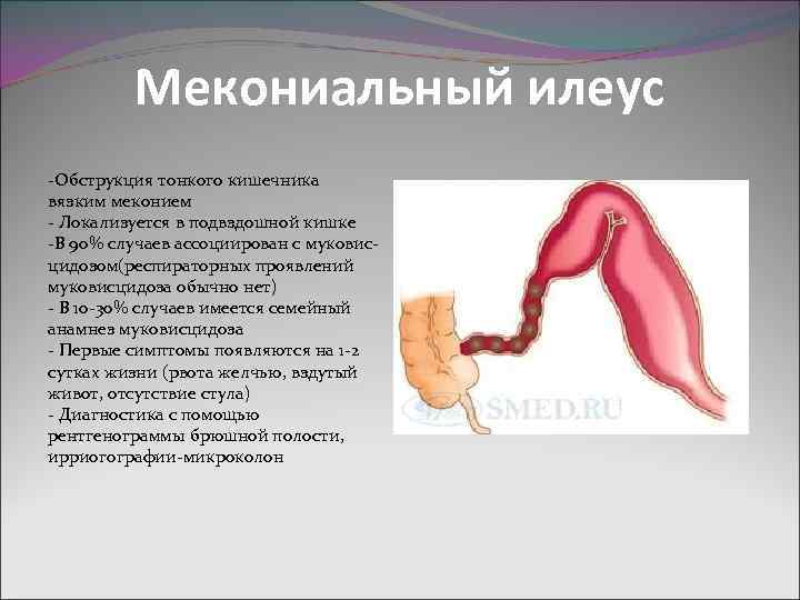 Мекониальный илеус -Обструкция тонкого кишечника вязким меконием - Локализуется в подвздошной кишке -В 90%