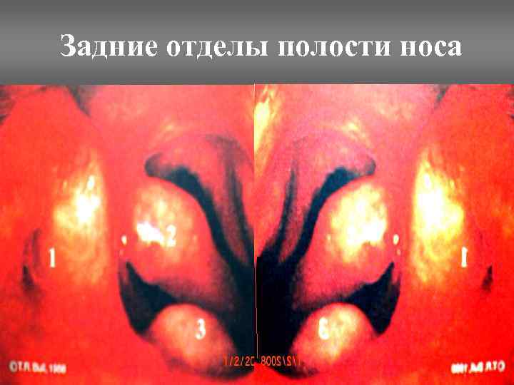Задние отделы полости носа 