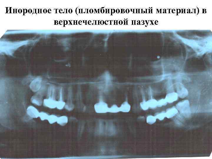 Инородное тело (пломбировочный материал) в верхнечелюстной пазухе 