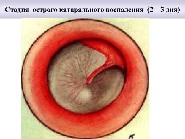 Стадия острого катарального воспаления (2 – 3 дня) 