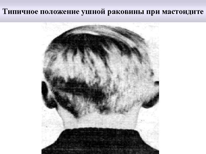 Типичное положение ушной раковины при мастоидите 